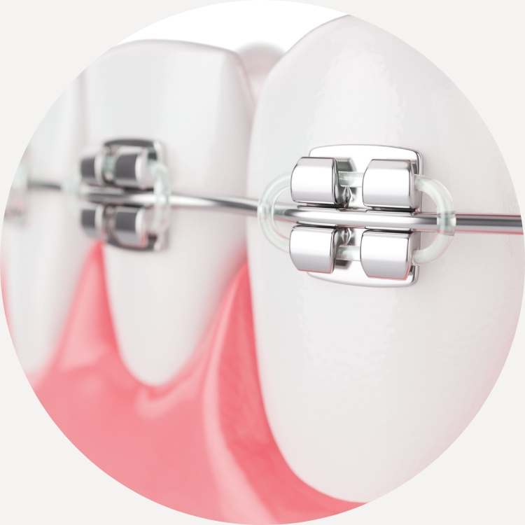 Brackets adulto Iquique Brackets adulto Iquique